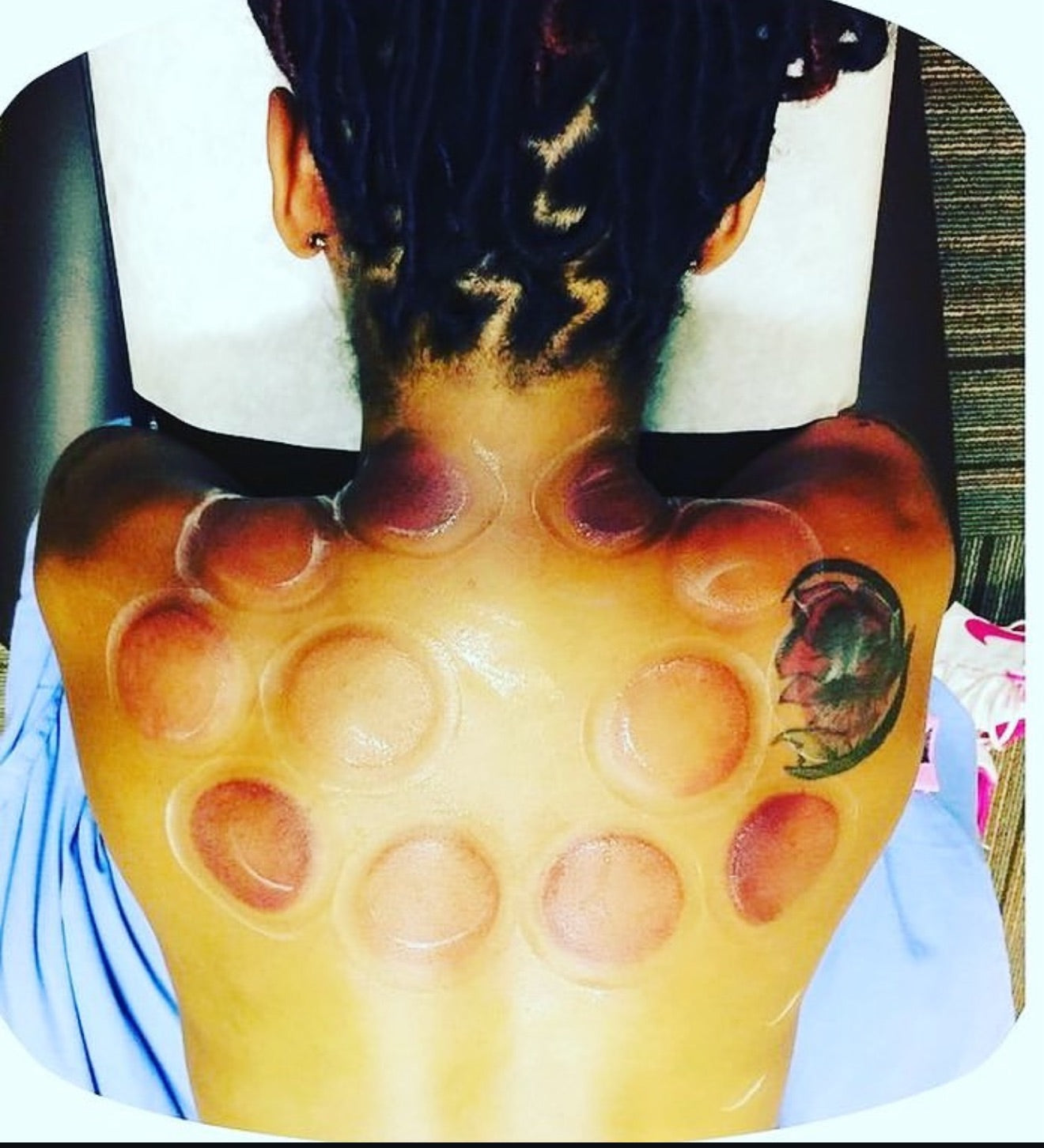 Cupping Therapy